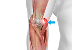 Hyperextension Injury of the Elbow